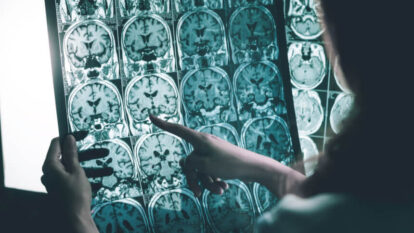 Alzheimer: o maior avanço até agora